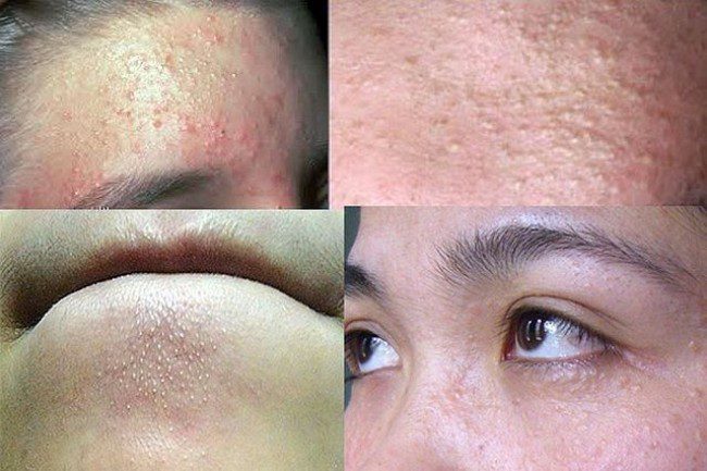 Những khu vực dễ xuất hiện mụn ẩn Những khu vực dễ xuất hiện mụn ẩn