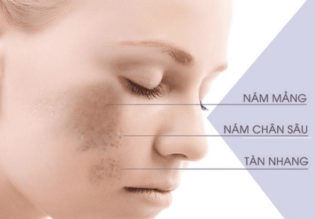 Hình ánh nám chân sâu (nám nội tiết)