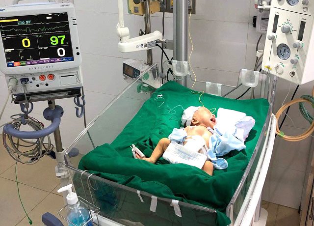 Hai ca phẫu thuật cứu sống trẻ sơ sinh mắc dị tật bẩm sinh có nội tạng bên ngoài ổ bụng Hai ca phẫu thuật cứu sống trẻ sơ sinh mắc dị tật bẩm sinh có nội tạng bên ngoài ổ bụng