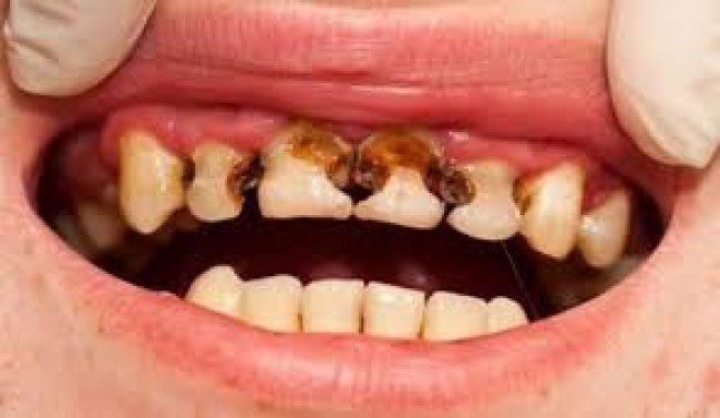 Sâu răng gây đau nhức cho bệnh nhân Sâu răng gây đau nhức cho bệnh nhân
