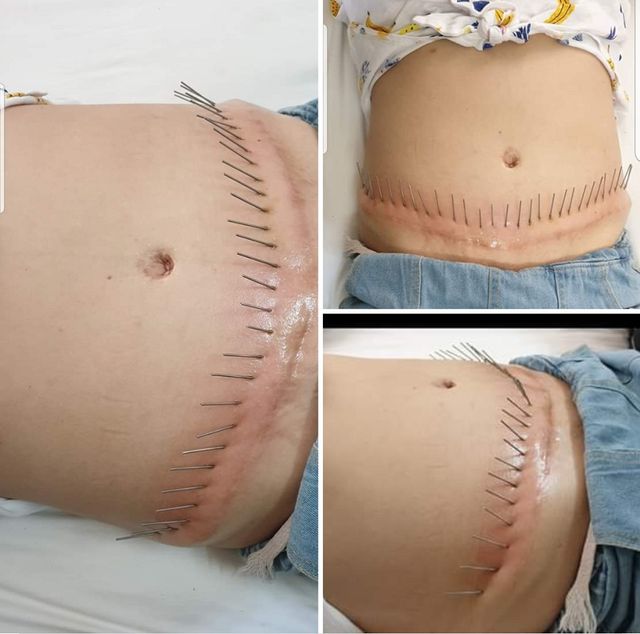 Chi vài triệu để trị sẹo Chi vài triệu để trị sẹo